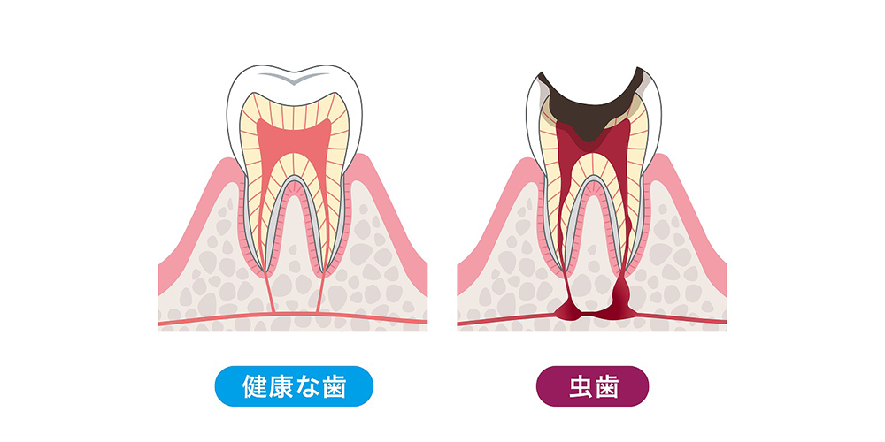 むし歯の原因