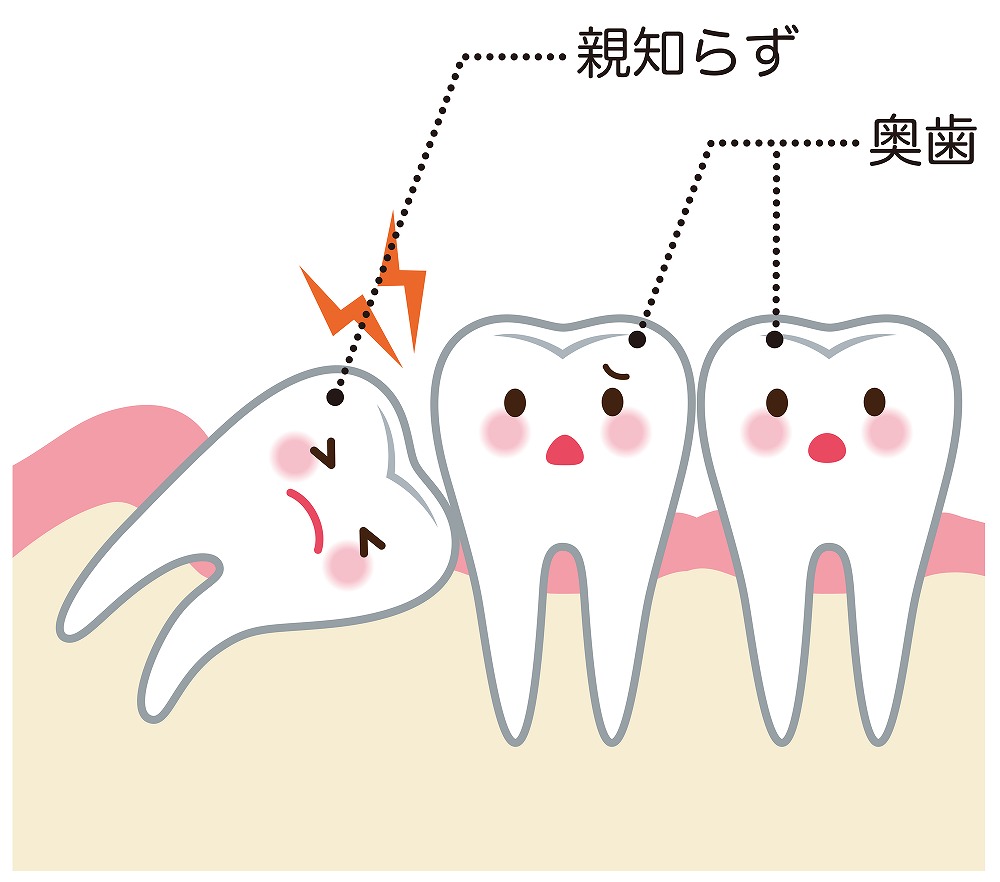 親知らずとは