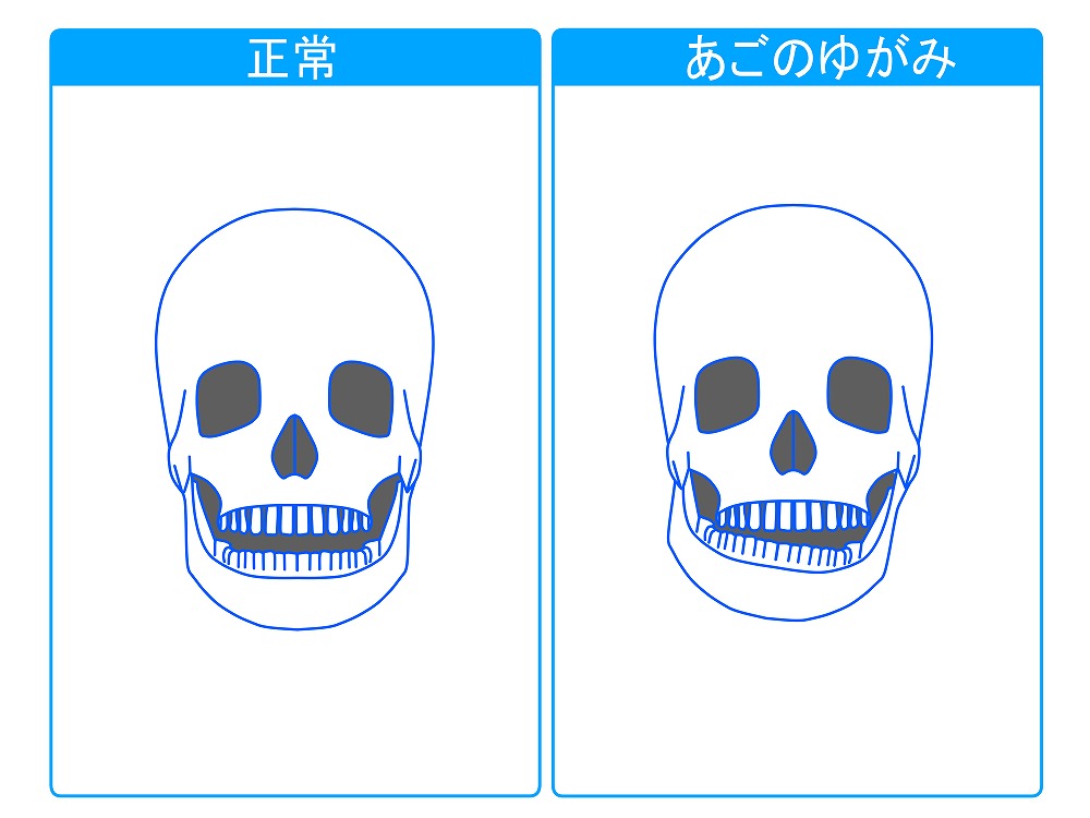 顎関節症