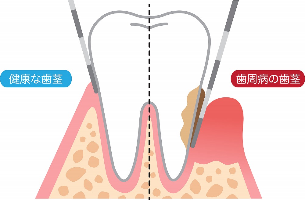 歯周病治療