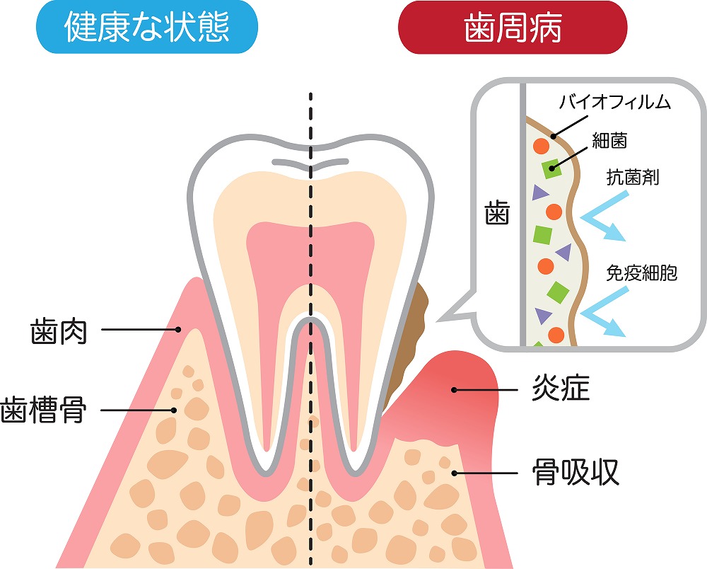 内服薬による痛みが少ない治療